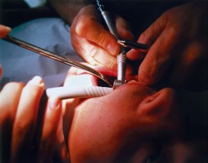 Amalgam und Glycol Zusammenhang