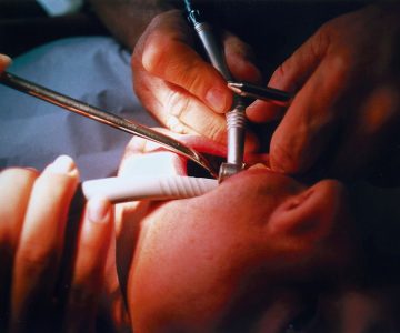 Amalgam und Glycol Zusammenhang